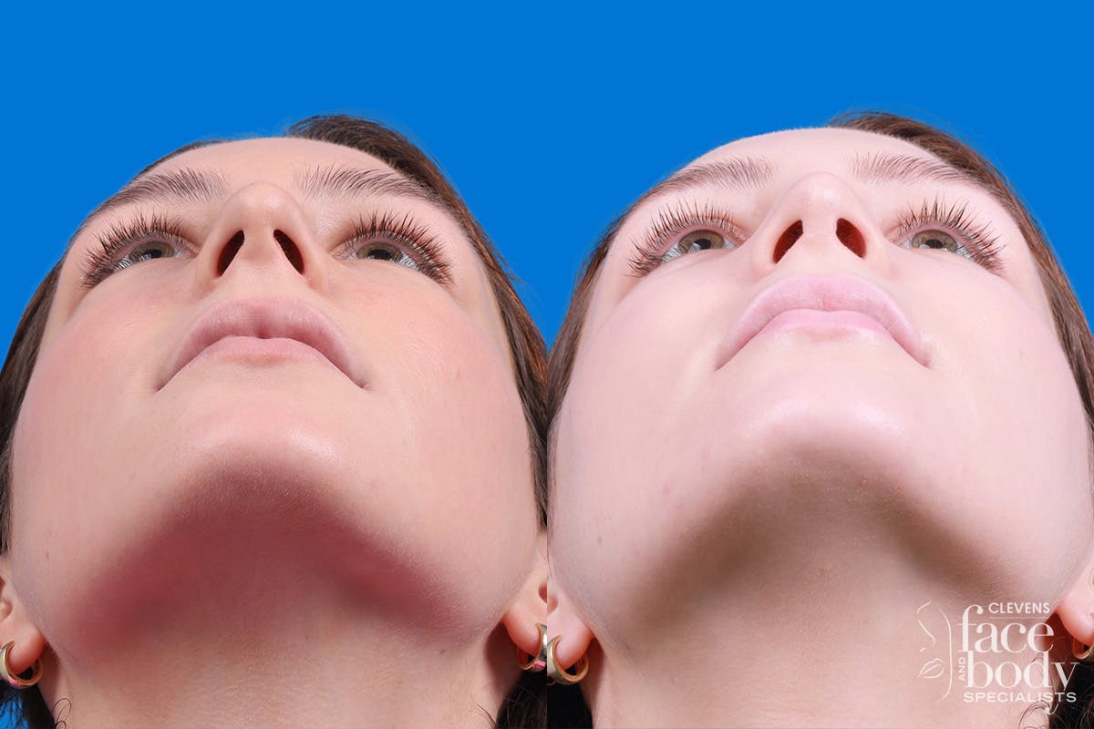 Rhinoplasty Before & After Gallery - Patient 405628 - Image 6