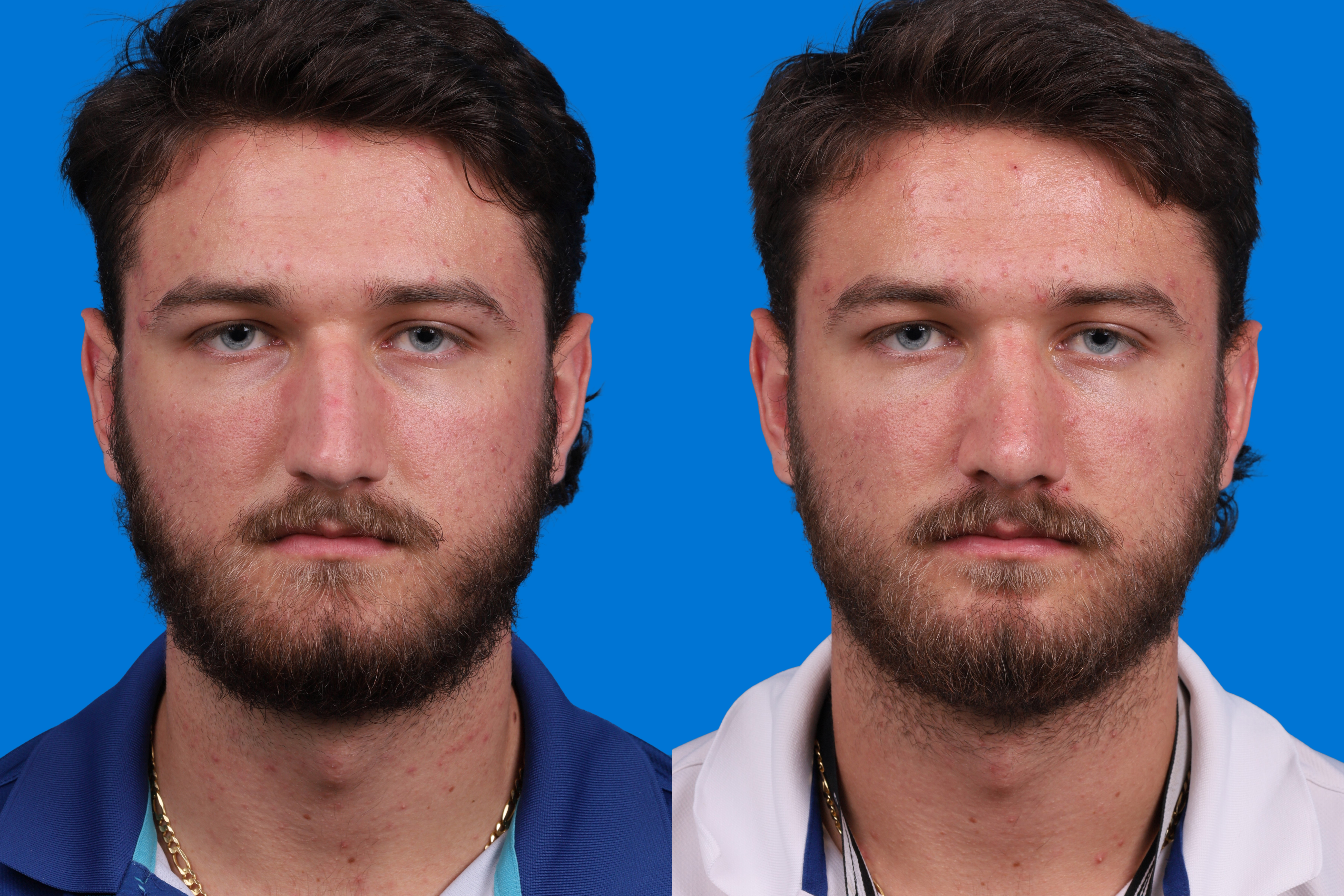 Rhinoplasty Before & After Gallery - Patient 268275 - Image 1