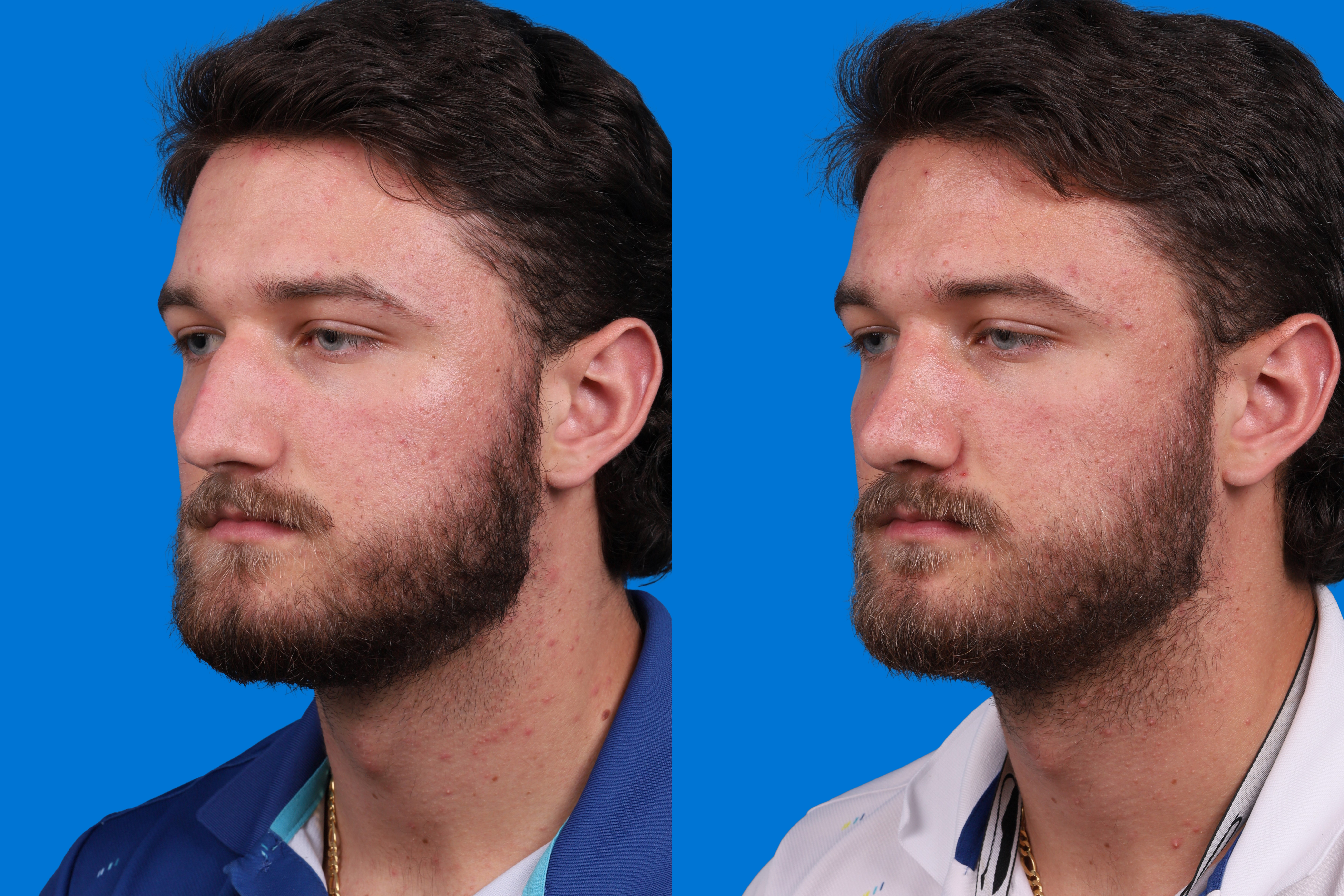 Rhinoplasty Before & After Gallery - Patient 268275 - Image 4