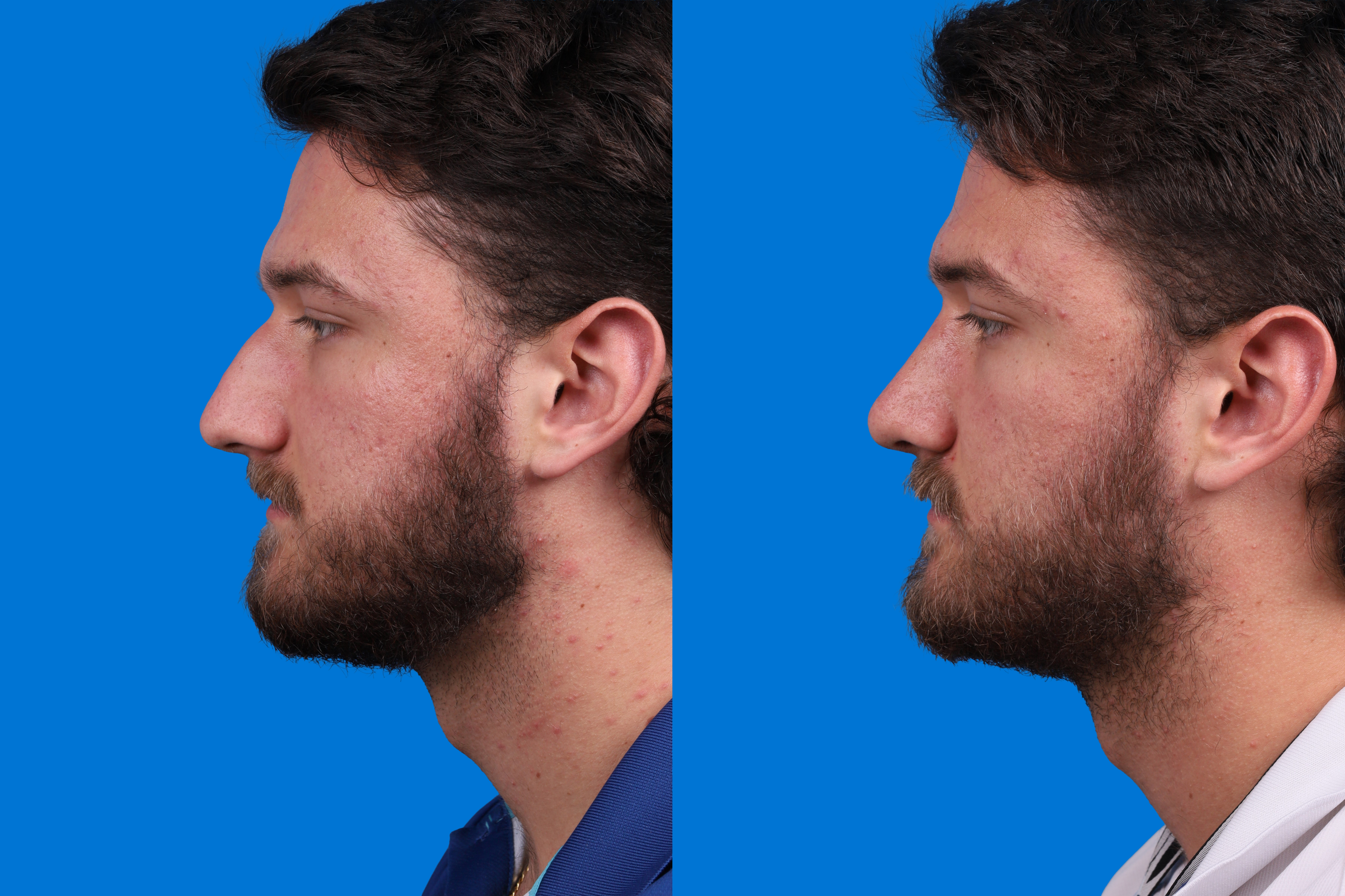 Rhinoplasty Before & After Gallery - Patient 268275 - Image 5