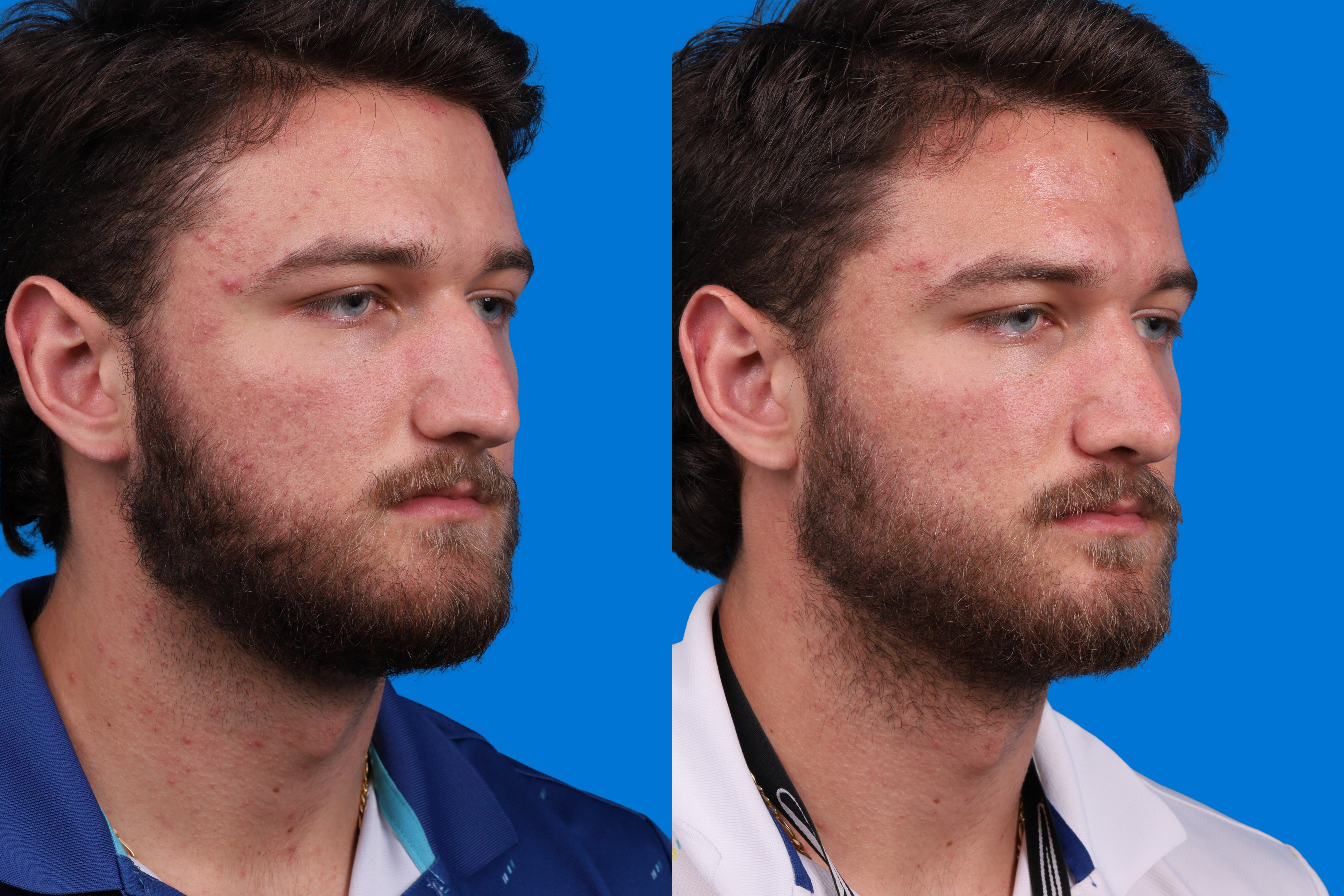 Rhinoplasty Before & After Gallery - Patient 268275 - Image 2