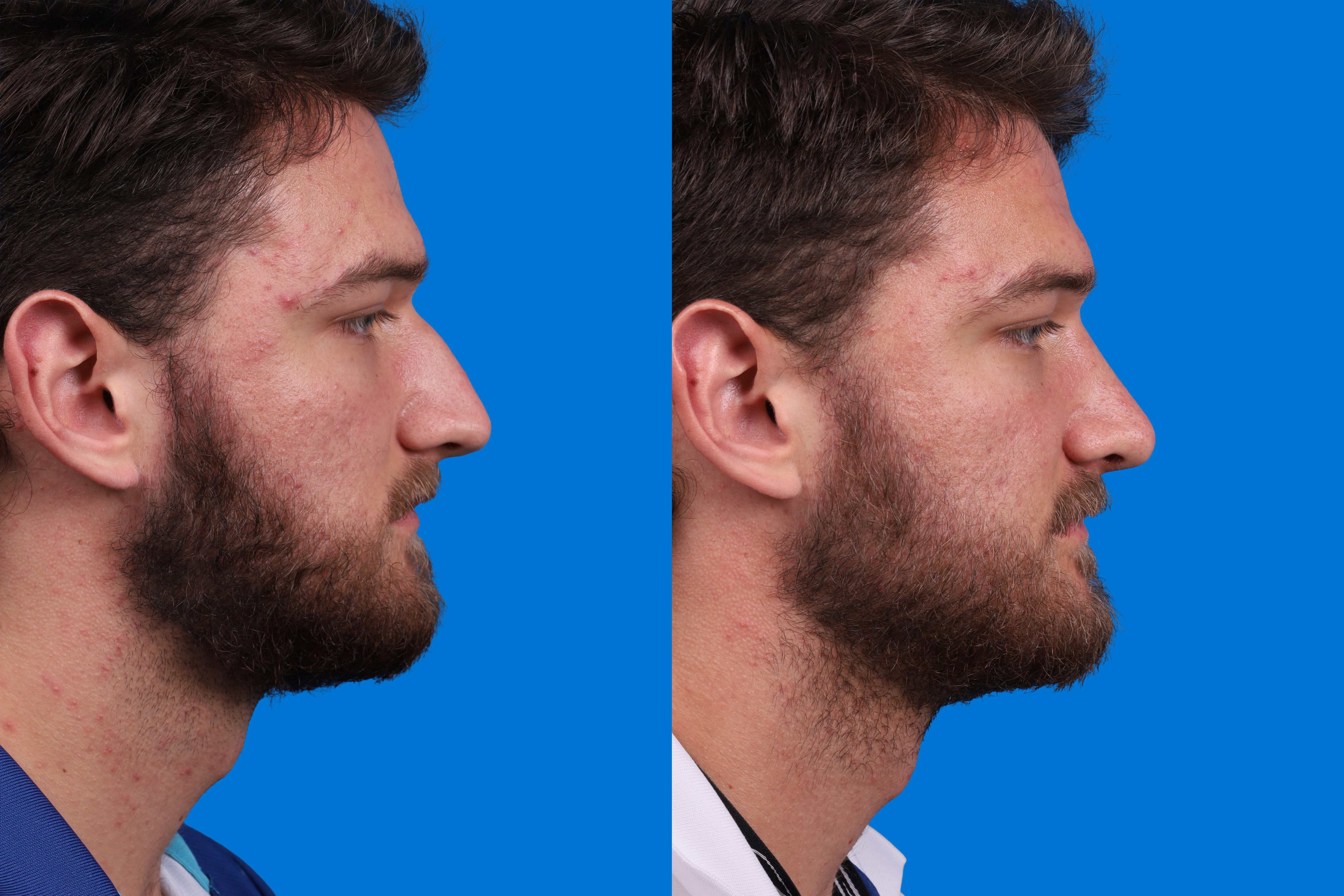 Rhinoplasty Before & After Gallery - Patient 268275 - Image 3