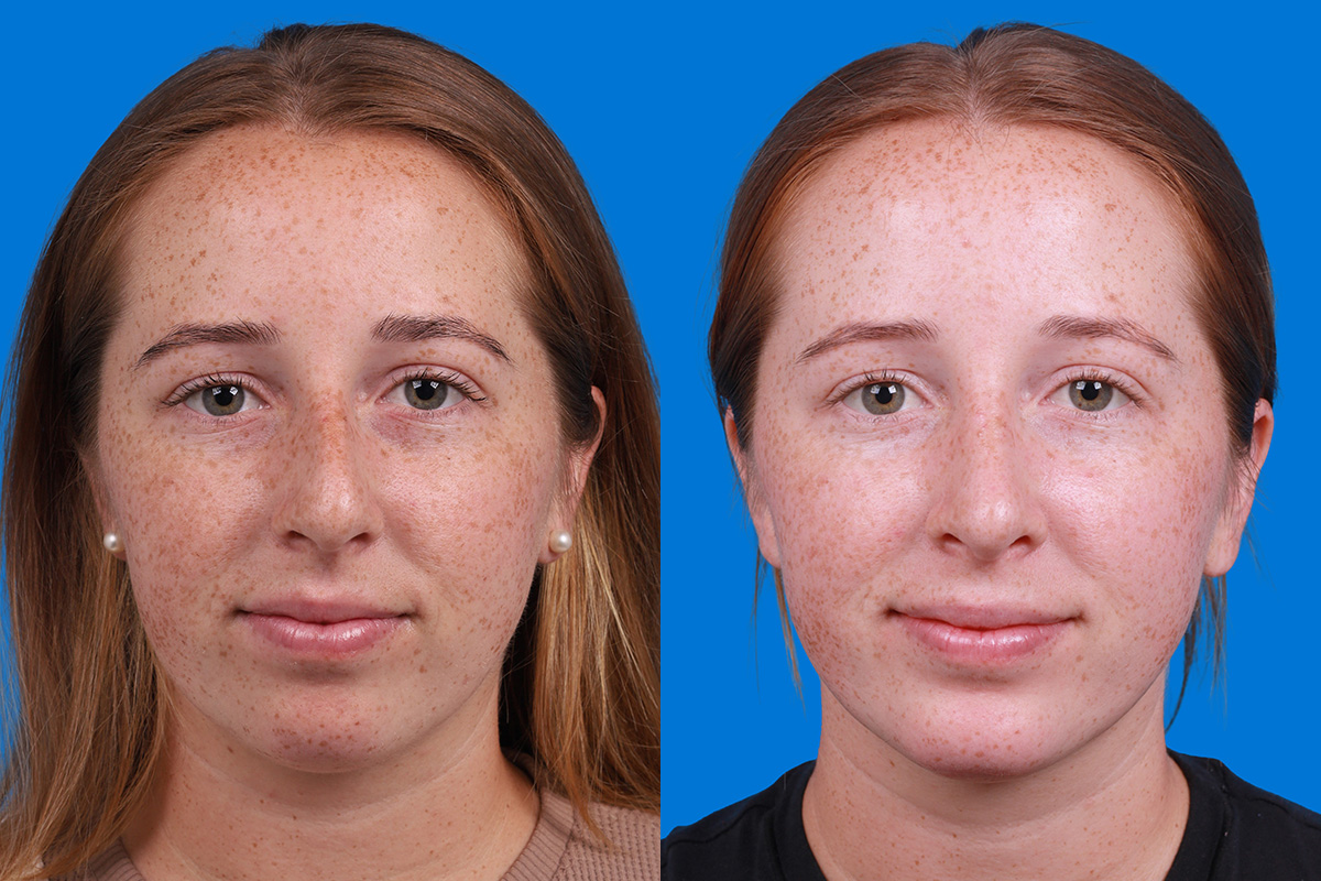 Rhinoplasty Before & After Gallery - Patient 128983 - Image 1