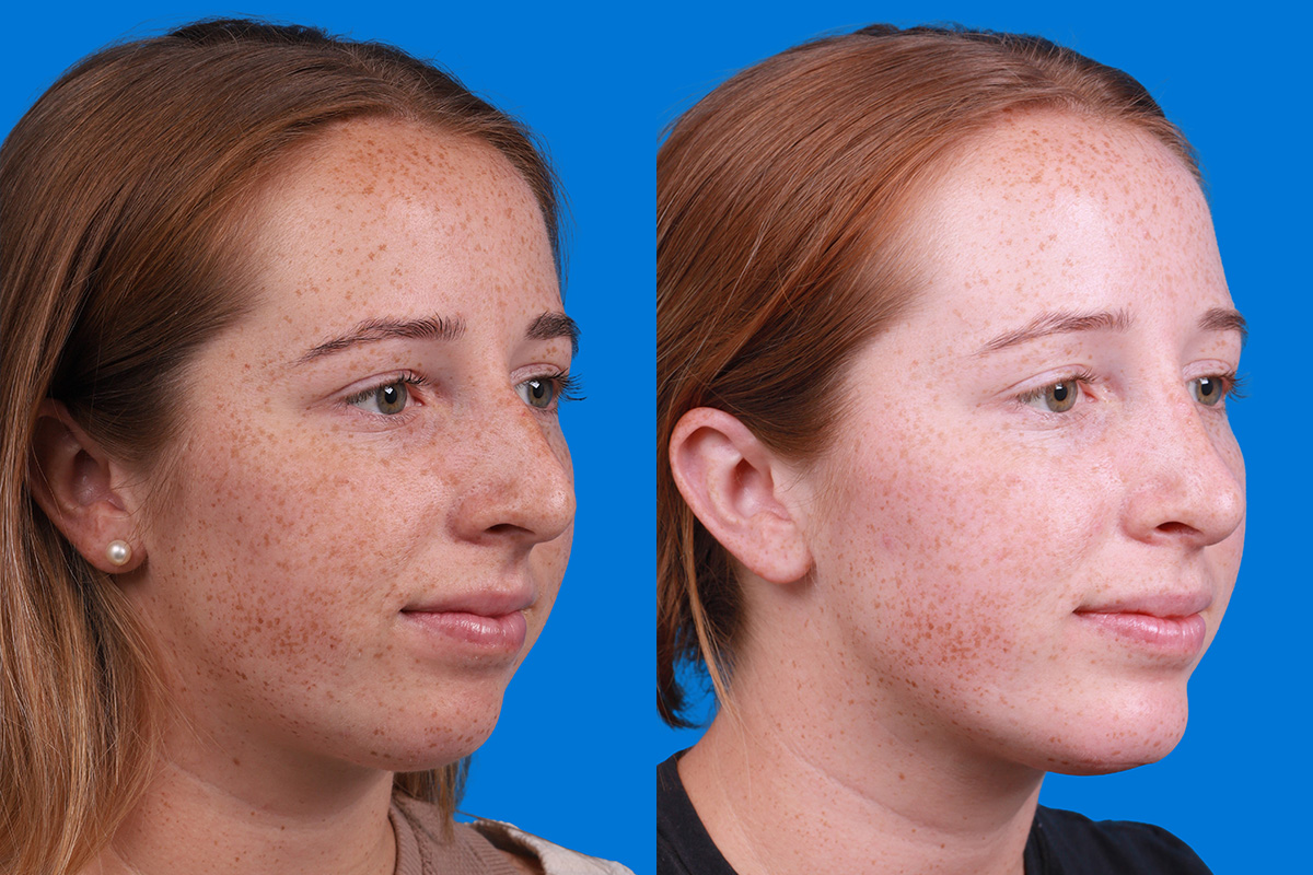 Rhinoplasty Before & After Gallery - Patient 128983 - Image 2