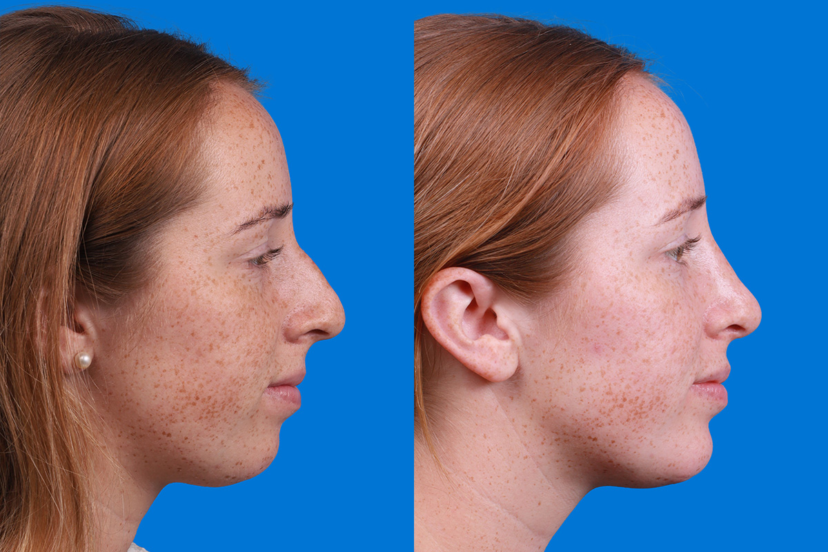 Rhinoplasty Before & After Gallery - Patient 128983 - Image 3