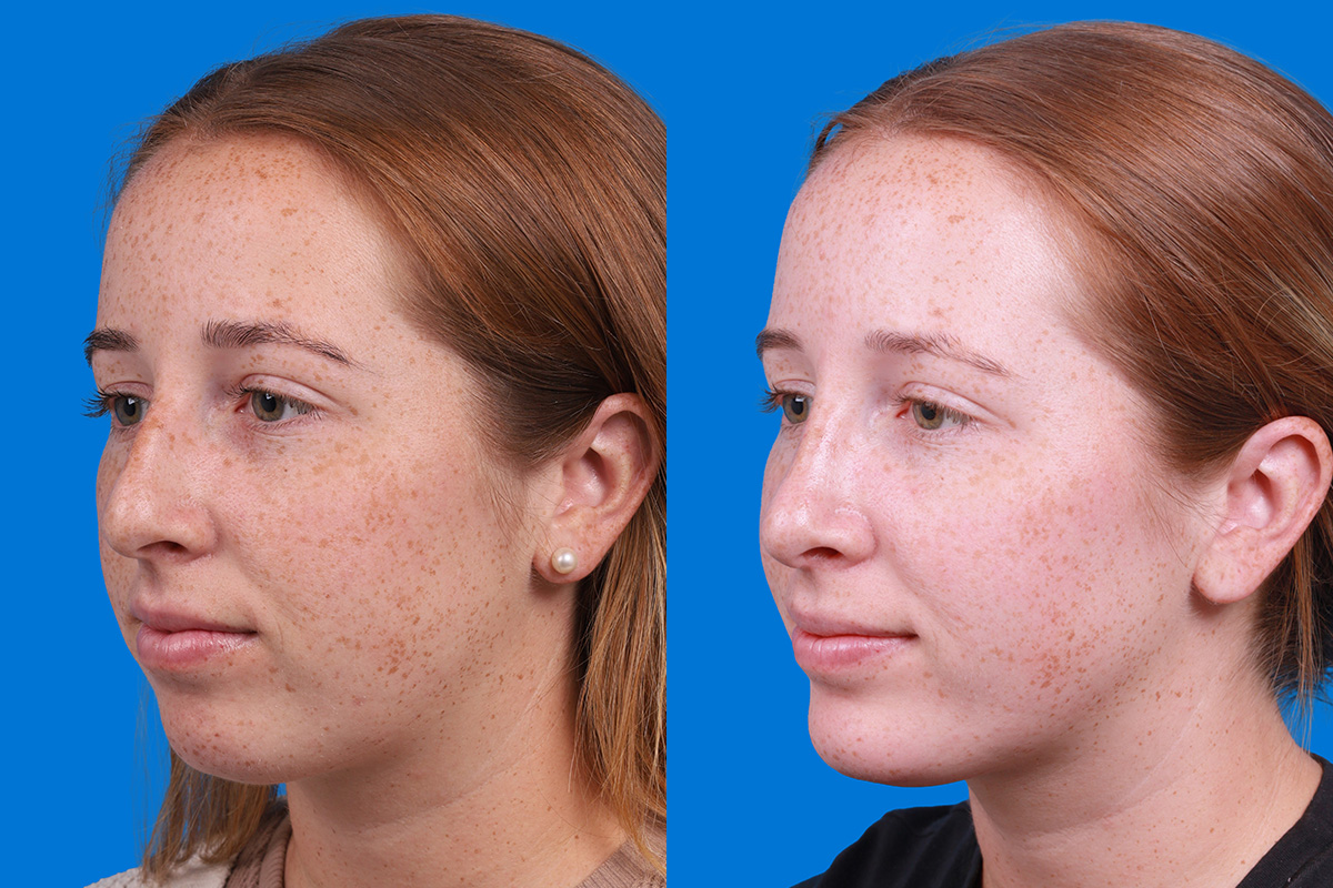 Rhinoplasty Before & After Gallery - Patient 128983 - Image 4