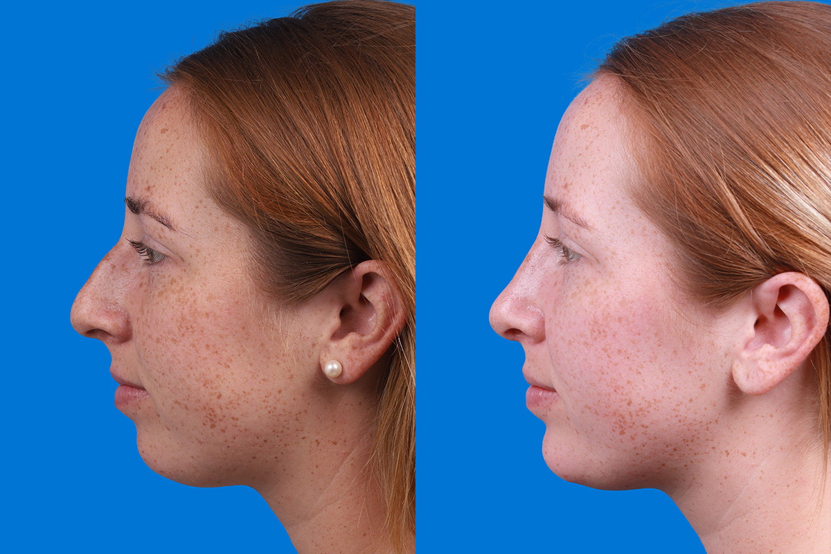 Rhinoplasty Before & After Gallery - Patient 128983 - Image 5