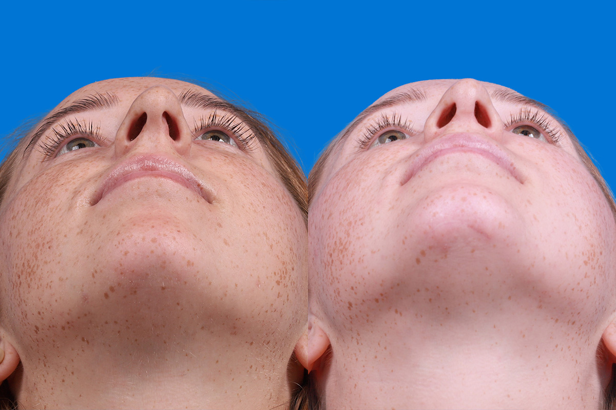 Rhinoplasty Before & After Gallery - Patient 128983 - Image 6