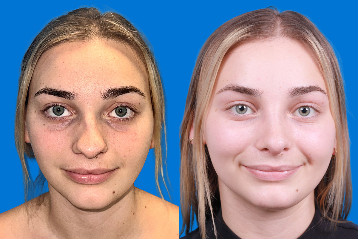 Rhinoplasty Before & After Gallery - Patient 362617 - Image 1