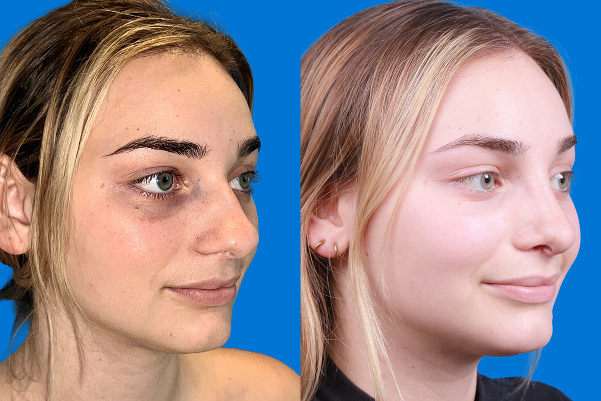 Rhinoplasty Before & After Gallery - Patient 362617 - Image 2