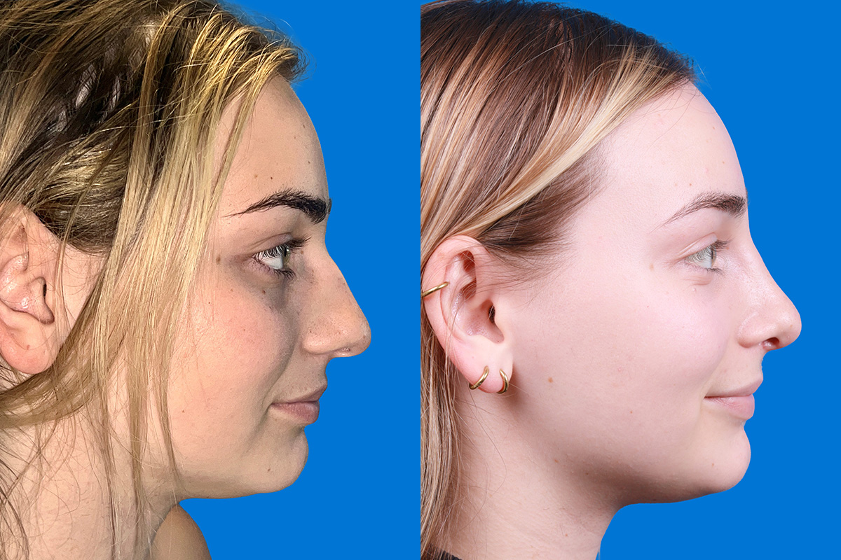 Rhinoplasty Before & After Gallery - Patient 362617 - Image 3
