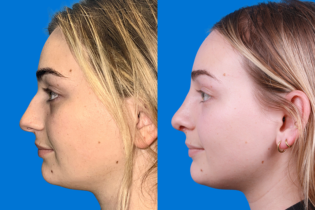 Rhinoplasty Before & After Gallery - Patient 362617 - Image 5