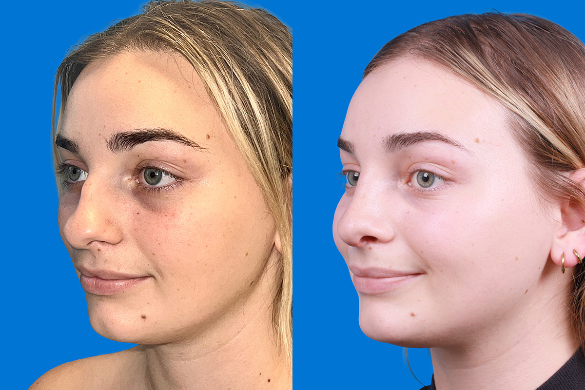 Rhinoplasty Before & After Gallery - Patient 362617 - Image 4
