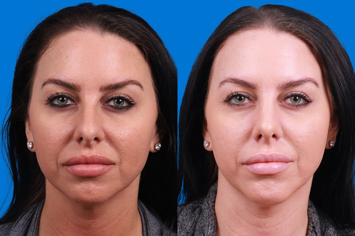 Rhinoplasty Before & After Gallery - Patient 146034 - Image 1