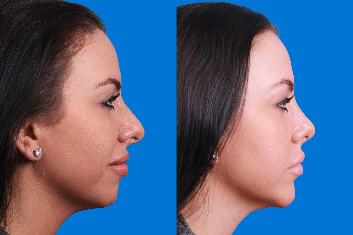 Rhinoplasty Before & After Gallery - Patient 146034 - Image 3