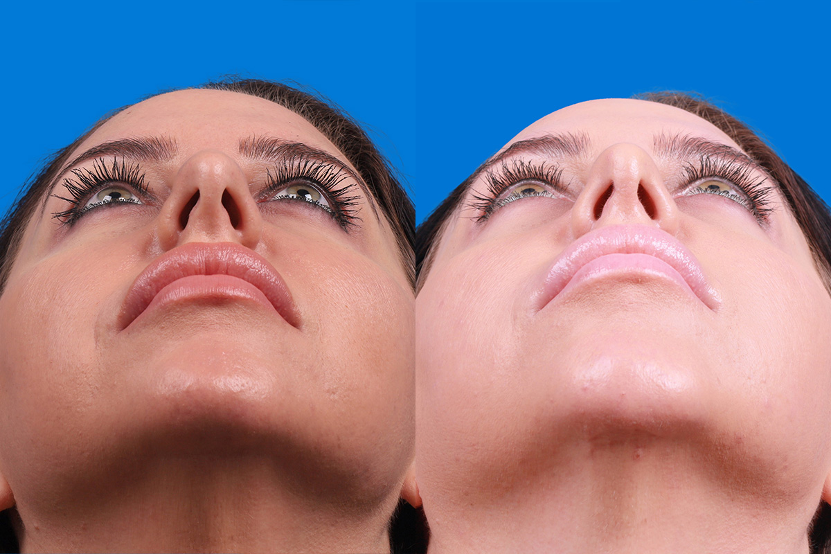 Rhinoplasty Before & After Gallery - Patient 146034 - Image 6
