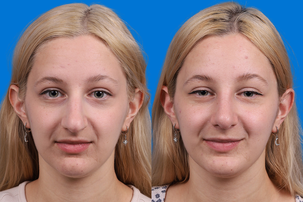 Rhinoplasty Before & After Gallery - Patient 577142 - Image 1