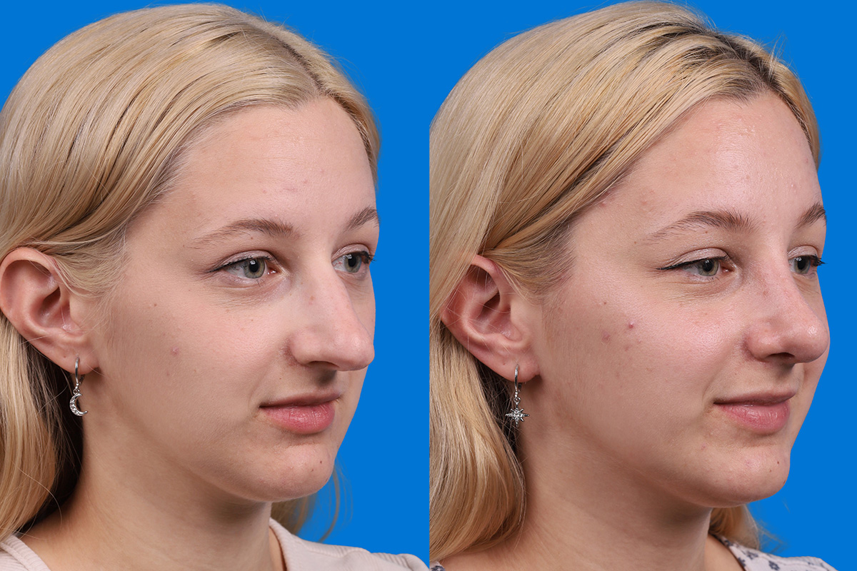 Rhinoplasty Before & After Gallery - Patient 577142 - Image 2
