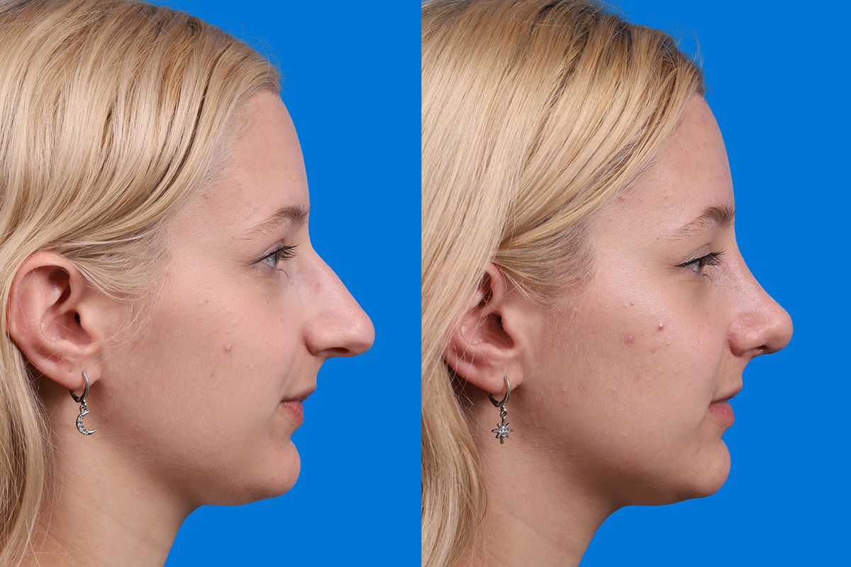 Rhinoplasty Before & After Gallery - Patient 577142 - Image 3
