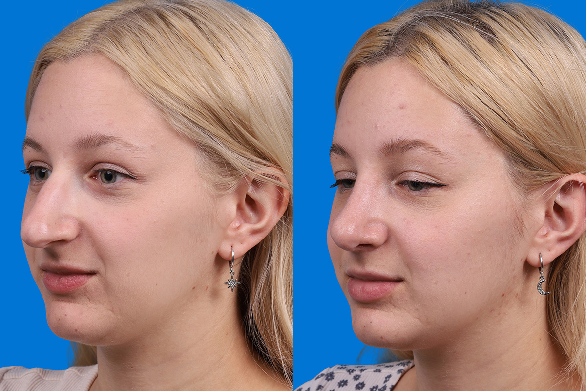 Rhinoplasty Before & After Gallery - Patient 577142 - Image 4
