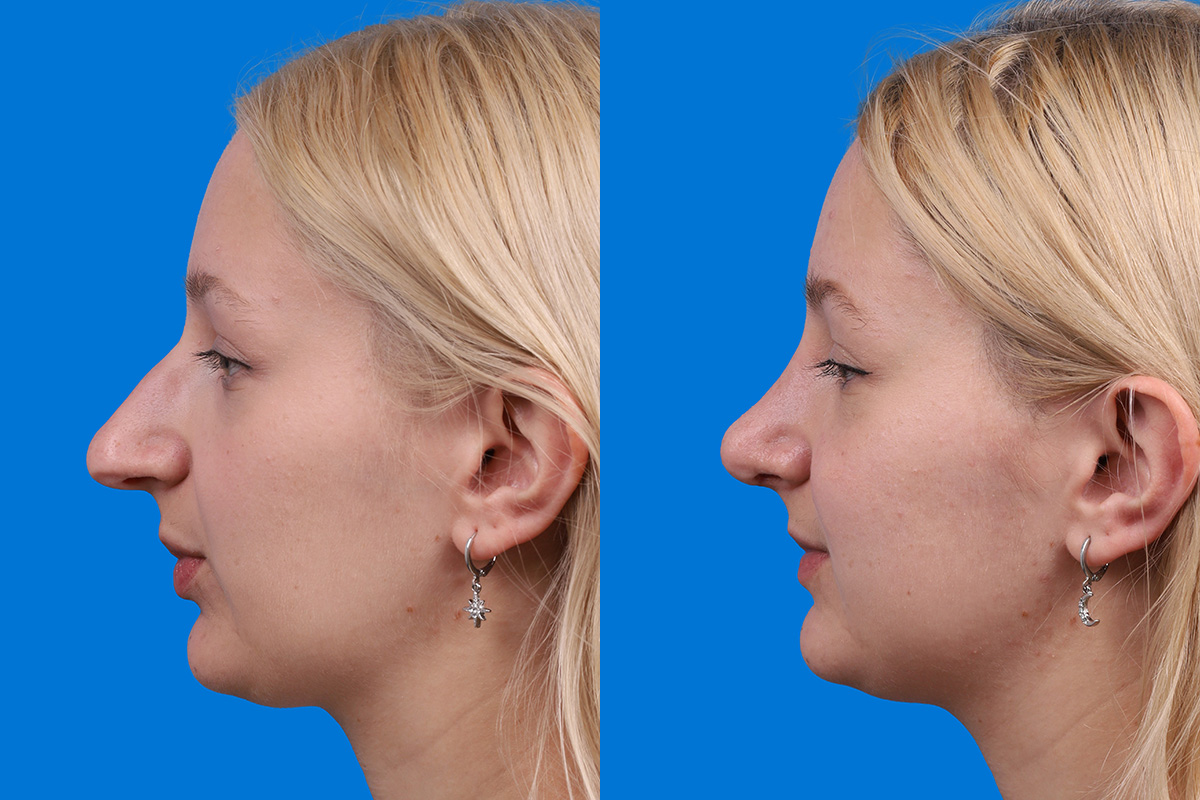 Rhinoplasty Before & After Gallery - Patient 577142 - Image 5