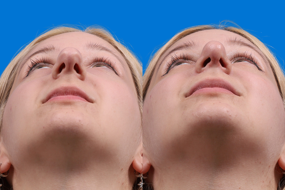 Rhinoplasty Before & After Gallery - Patient 577142 - Image 6