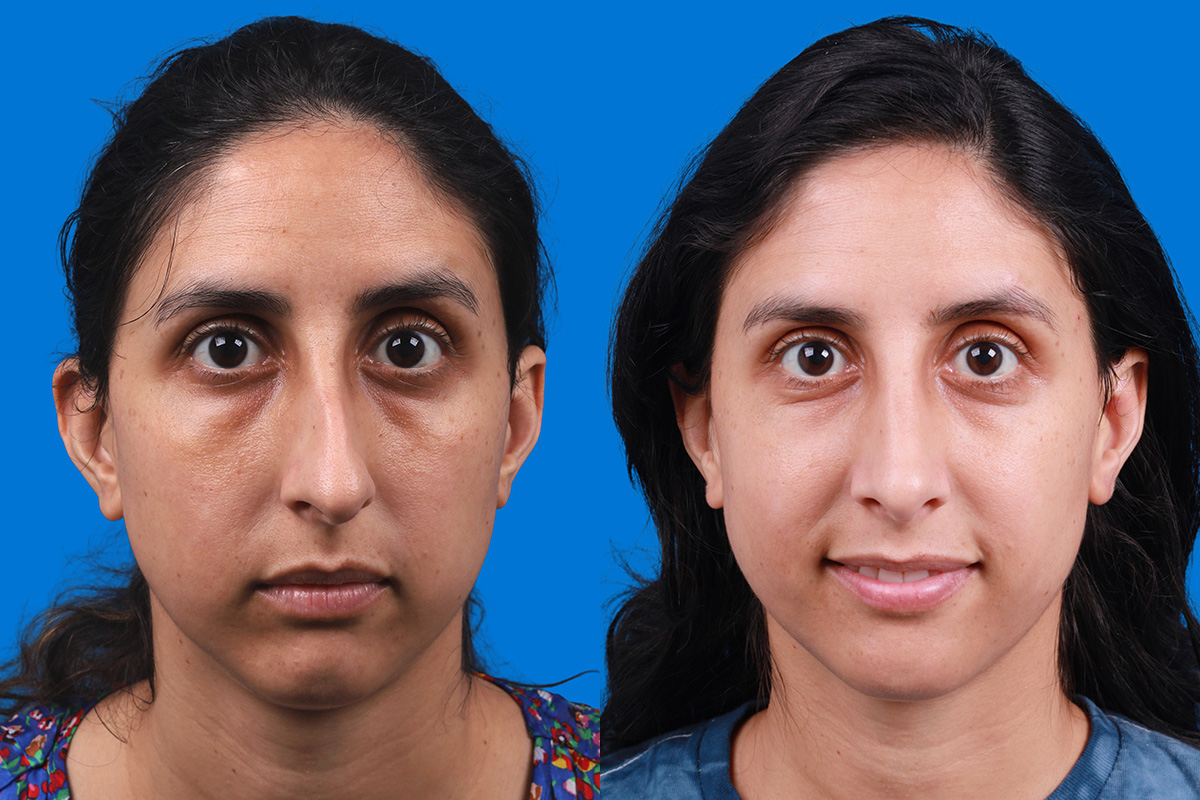 Rhinoplasty Before & After Gallery - Patient 174020983 - Image 1