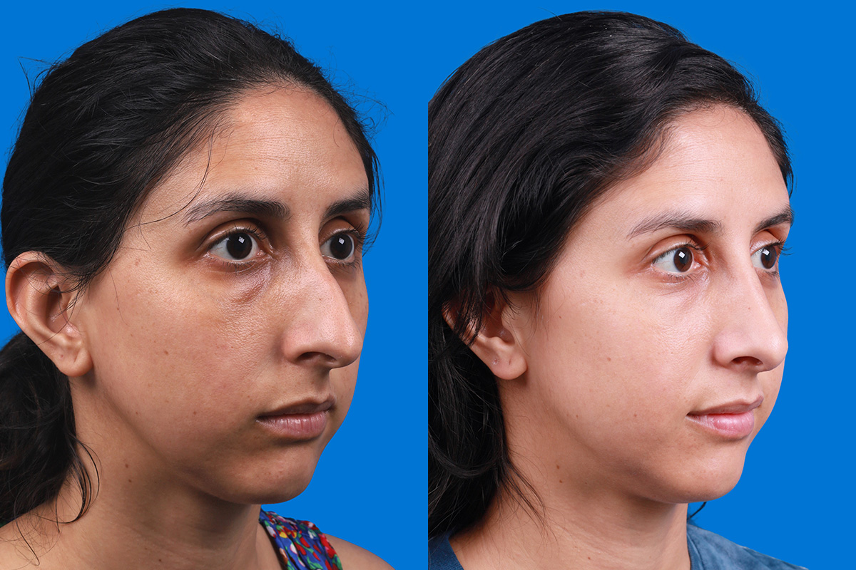 Rhinoplasty Before & After Gallery - Patient 174020983 - Image 2