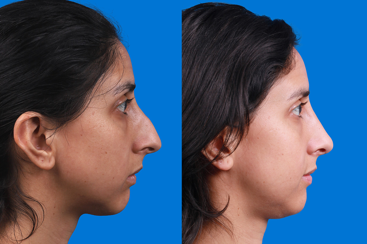 Rhinoplasty Before & After Gallery - Patient 174020983 - Image 3
