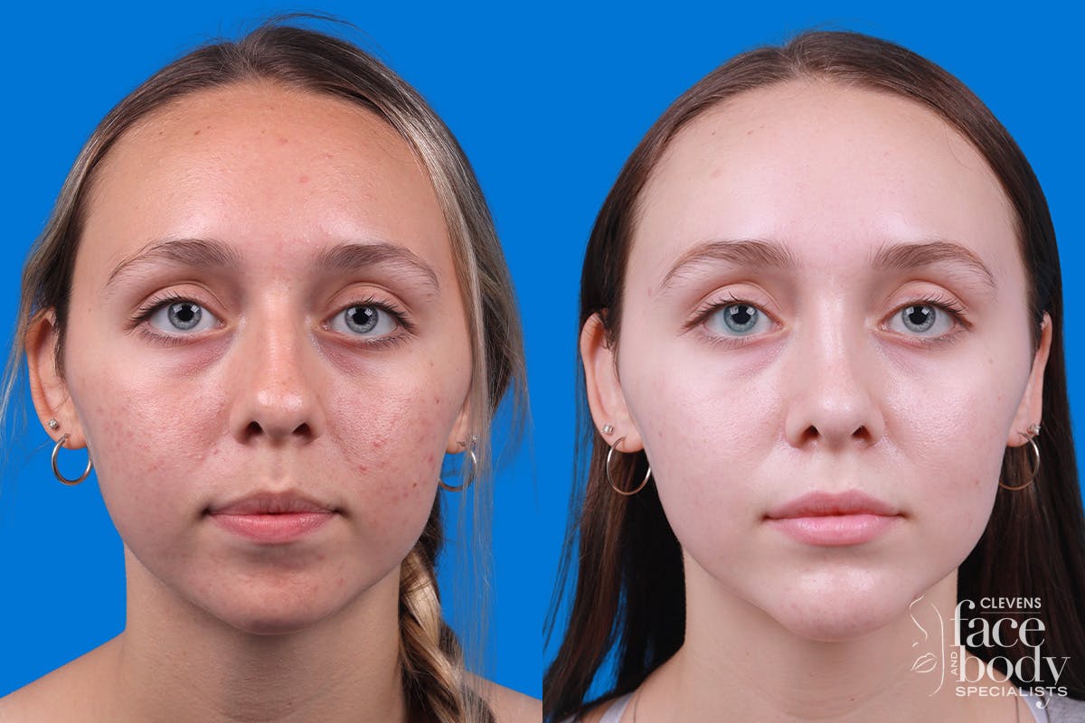Rhinoplasty Before & After Gallery - Patient 184320141 - Image 1
