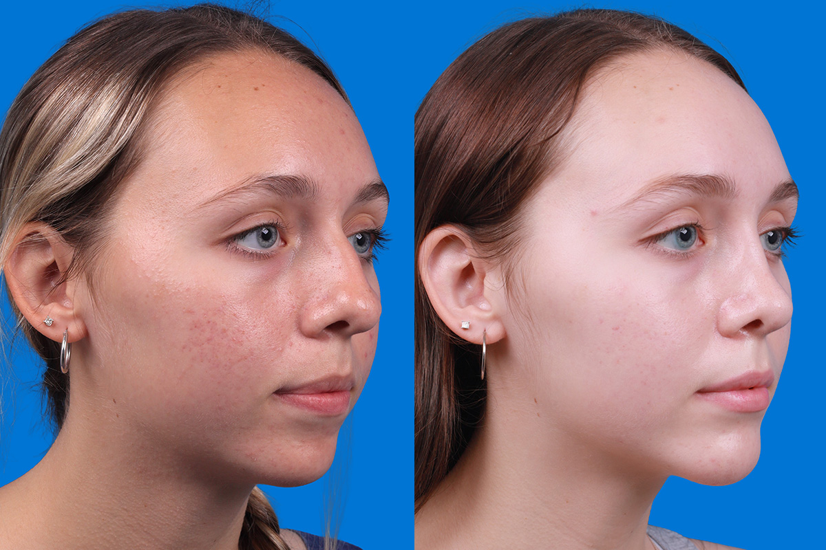 Rhinoplasty Before & After Gallery - Patient 184320141 - Image 2