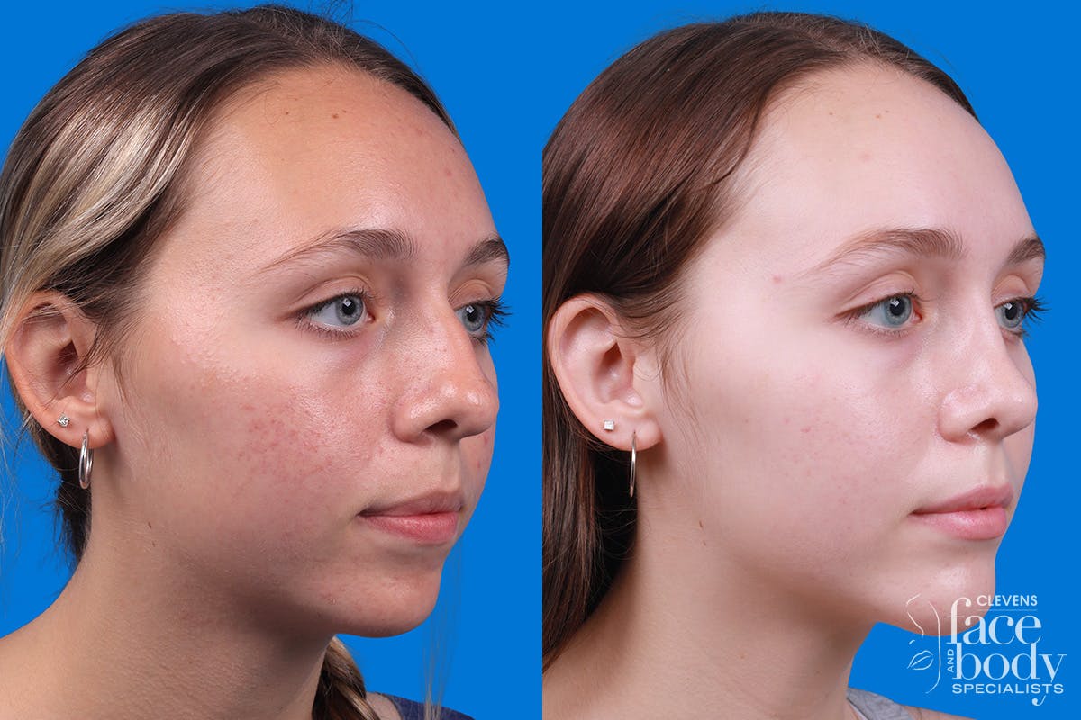 Rhinoplasty Before & After Gallery - Patient 184320141 - Image 2