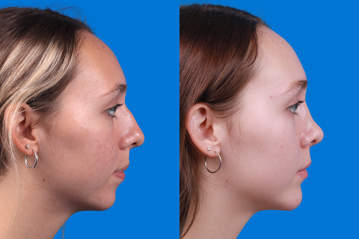 Rhinoplasty Before & After Gallery - Patient 184320141 - Image 3
