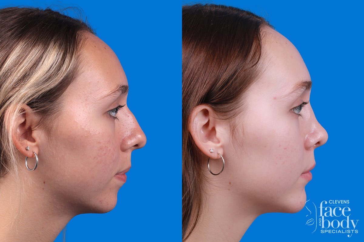 Rhinoplasty Before & After Gallery - Patient 184320141 - Image 3