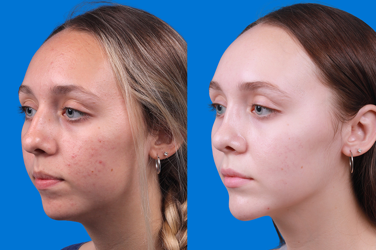 Rhinoplasty Before & After Gallery - Patient 184320141 - Image 4