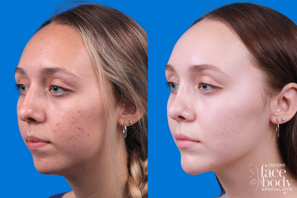 Rhinoplasty Before & After Gallery - Patient 184320141 - Image 4