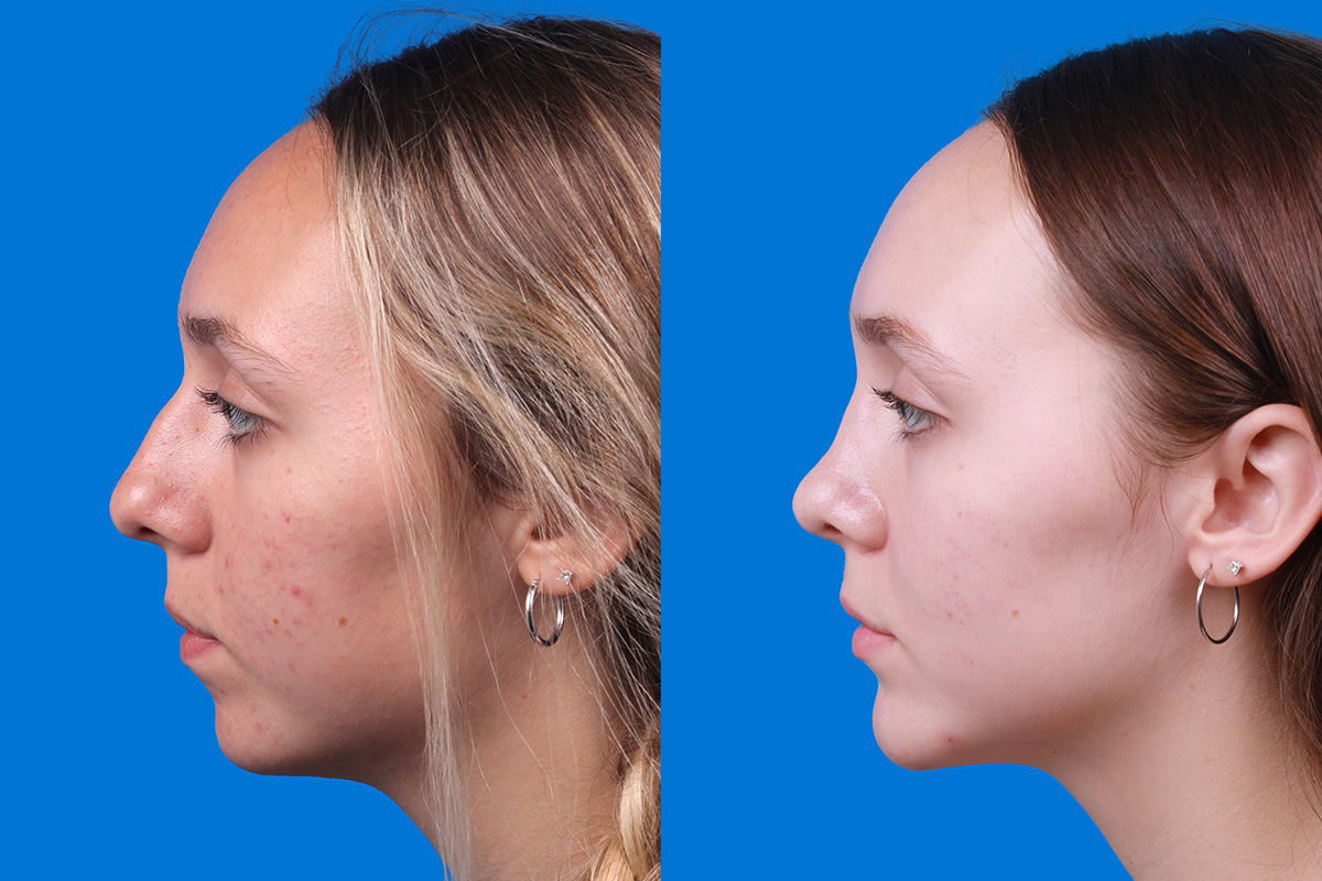 Rhinoplasty Before & After Gallery - Patient 184320141 - Image 5
