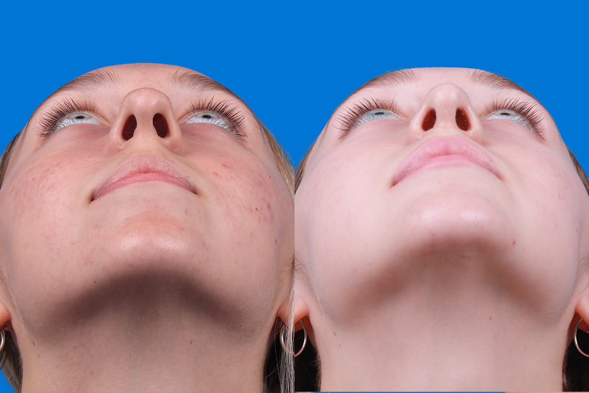 Rhinoplasty Before & After Gallery - Patient 184320141 - Image 6