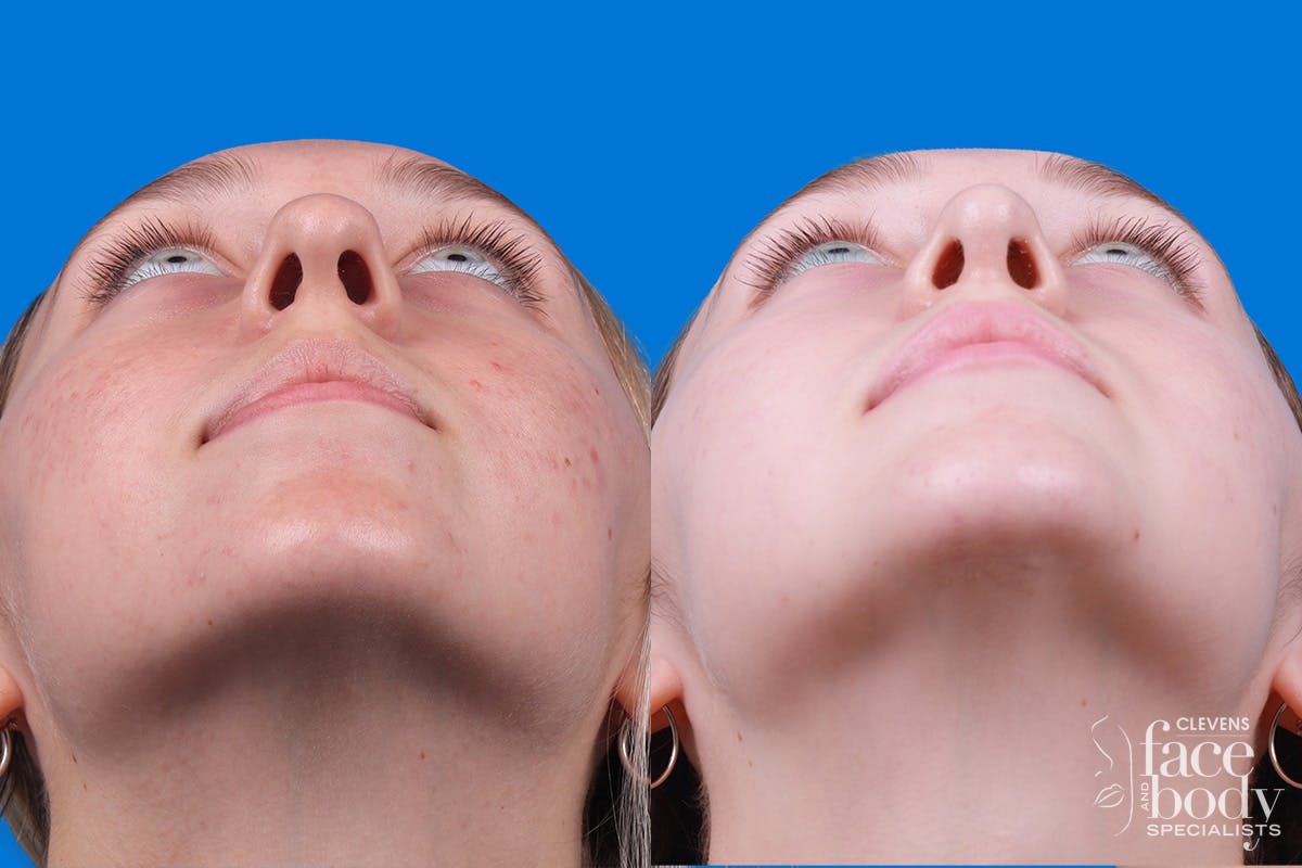 Rhinoplasty Before & After Gallery - Patient 184320141 - Image 6