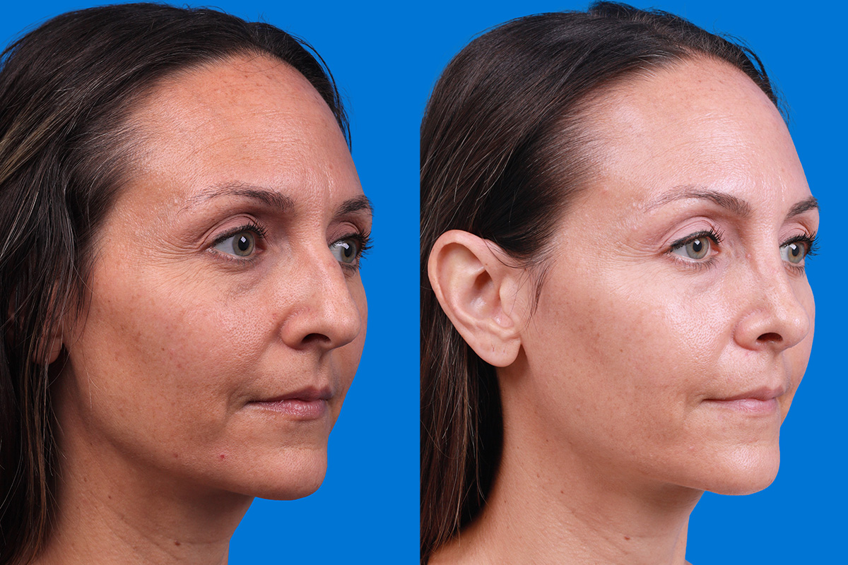 Rhinoplasty Before & After Gallery - Patient 188712747 - Image 2