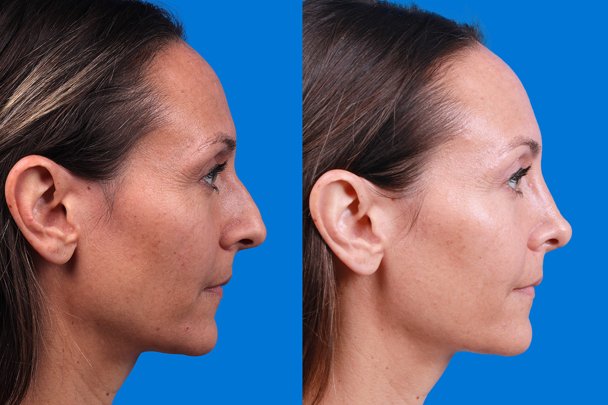 Rhinoplasty Before & After Gallery - Patient 188712747 - Image 3