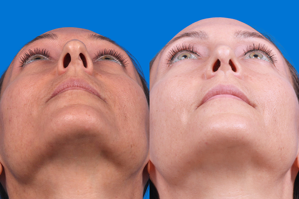 Rhinoplasty Before & After Gallery - Patient 188712747 - Image 6