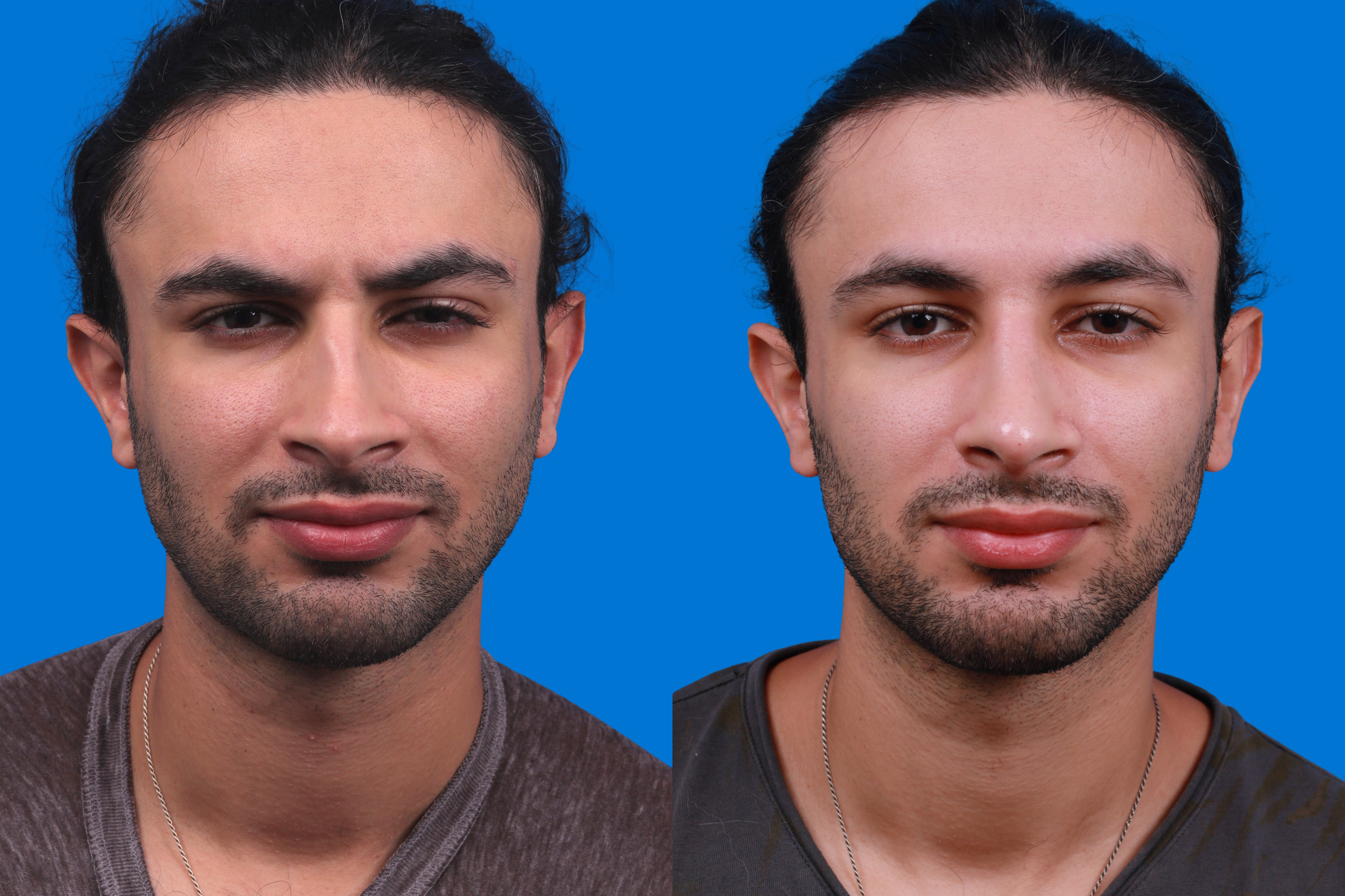 Rhinoplasty Before & After Gallery - Patient 179166674 - Image 1