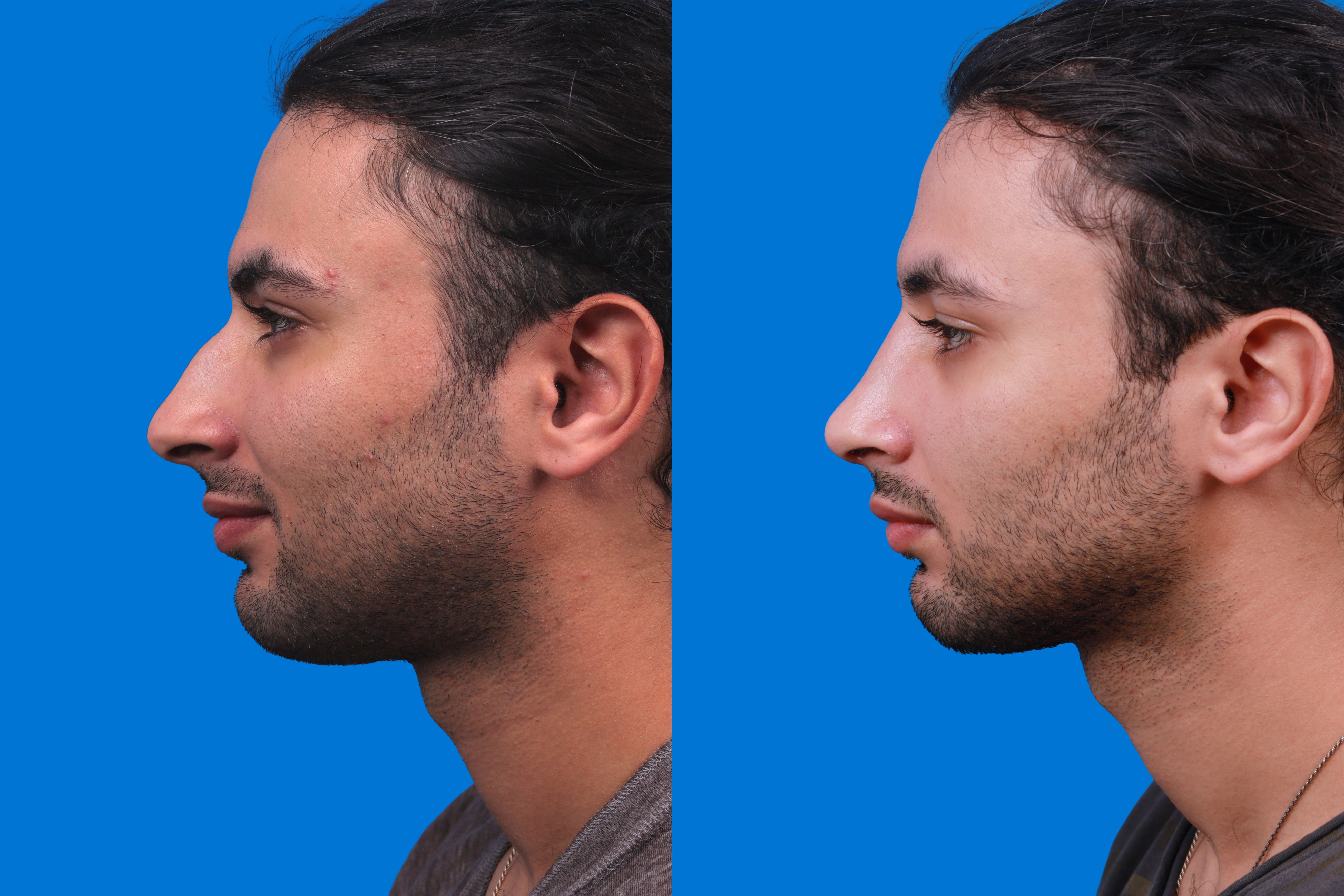 Rhinoplasty Before & After Gallery - Patient 179166674 - Image 5
