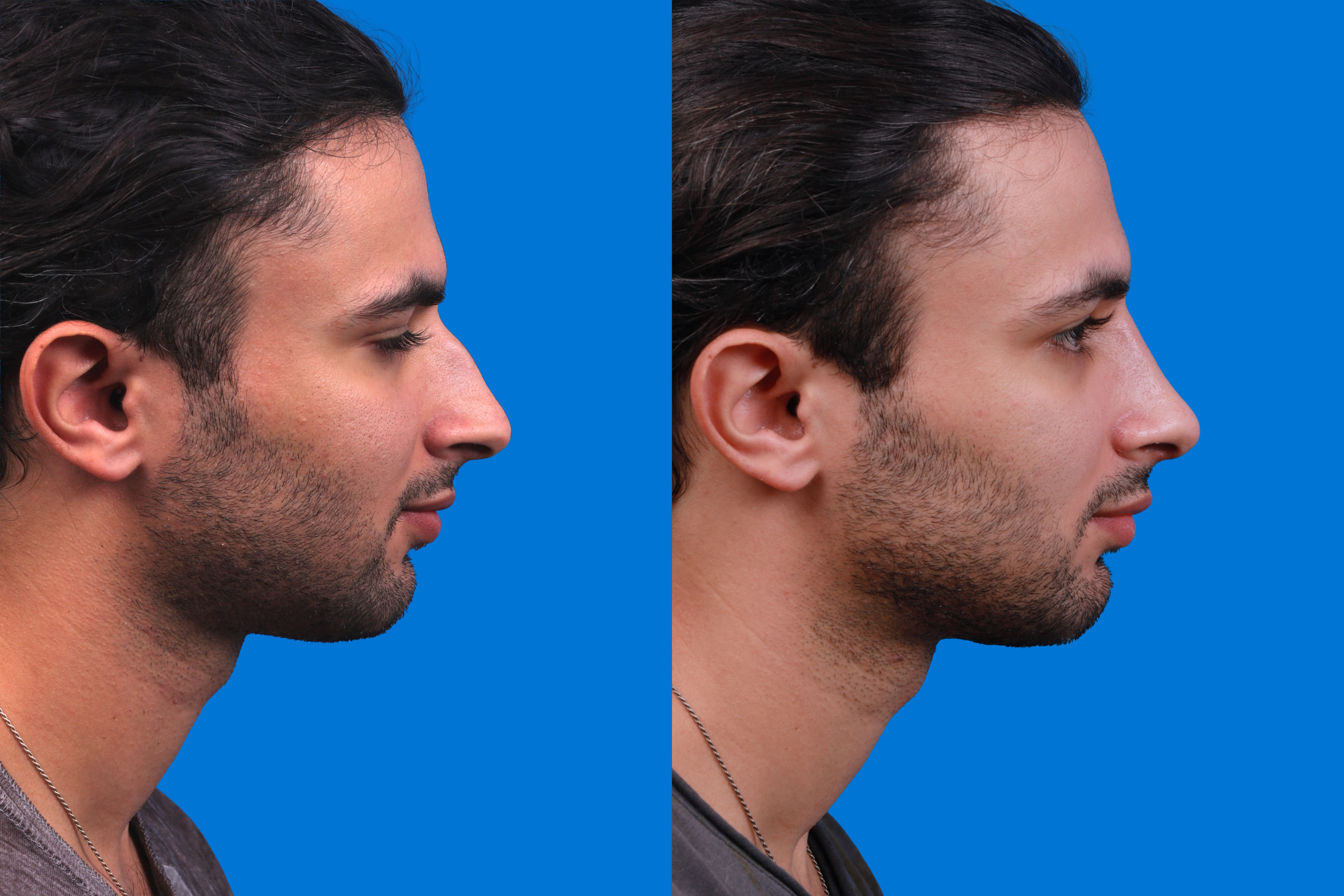 Rhinoplasty Before & After Gallery - Patient 179166674 - Image 3