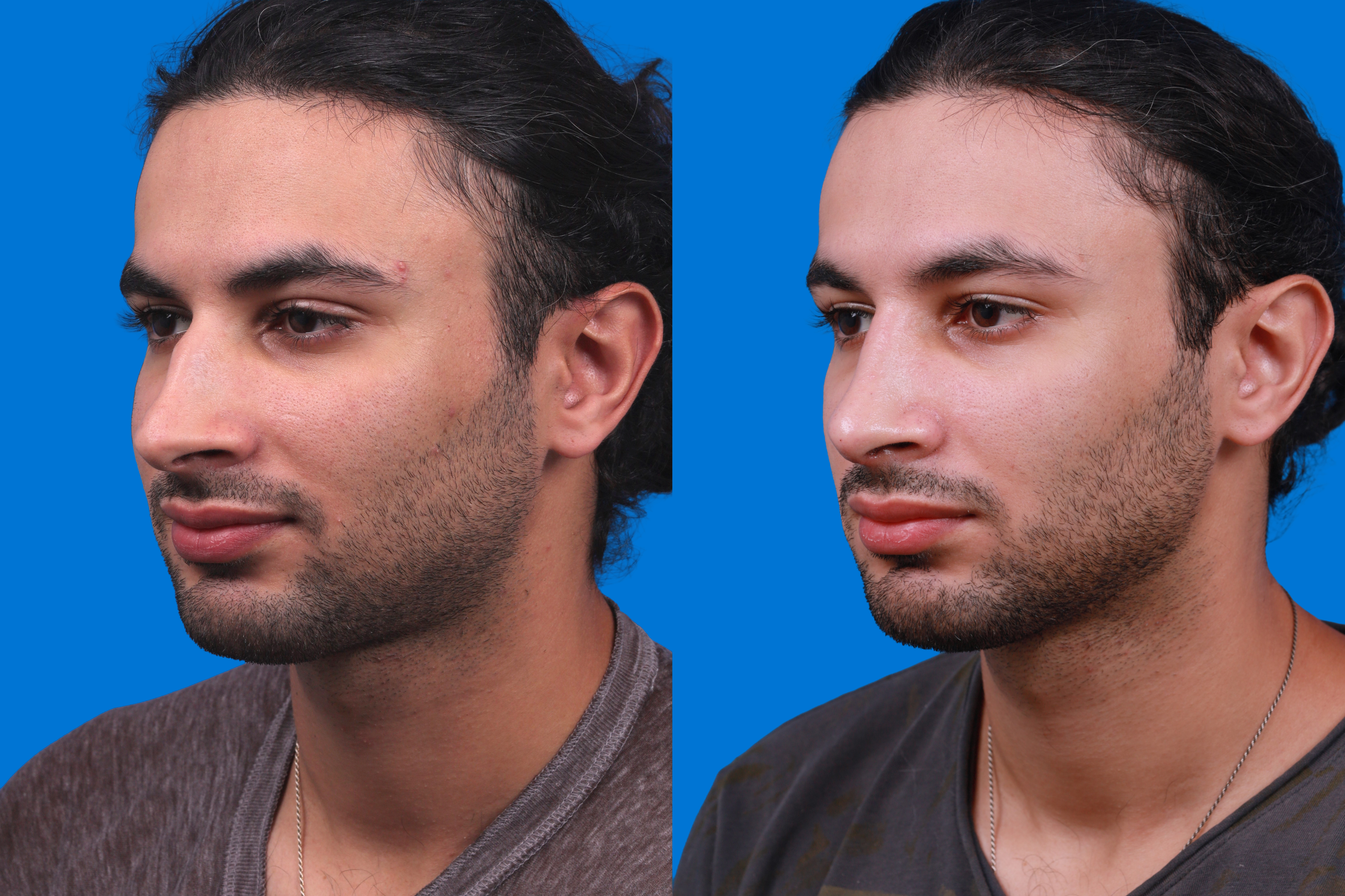 Rhinoplasty Before & After Gallery - Patient 179166674 - Image 4