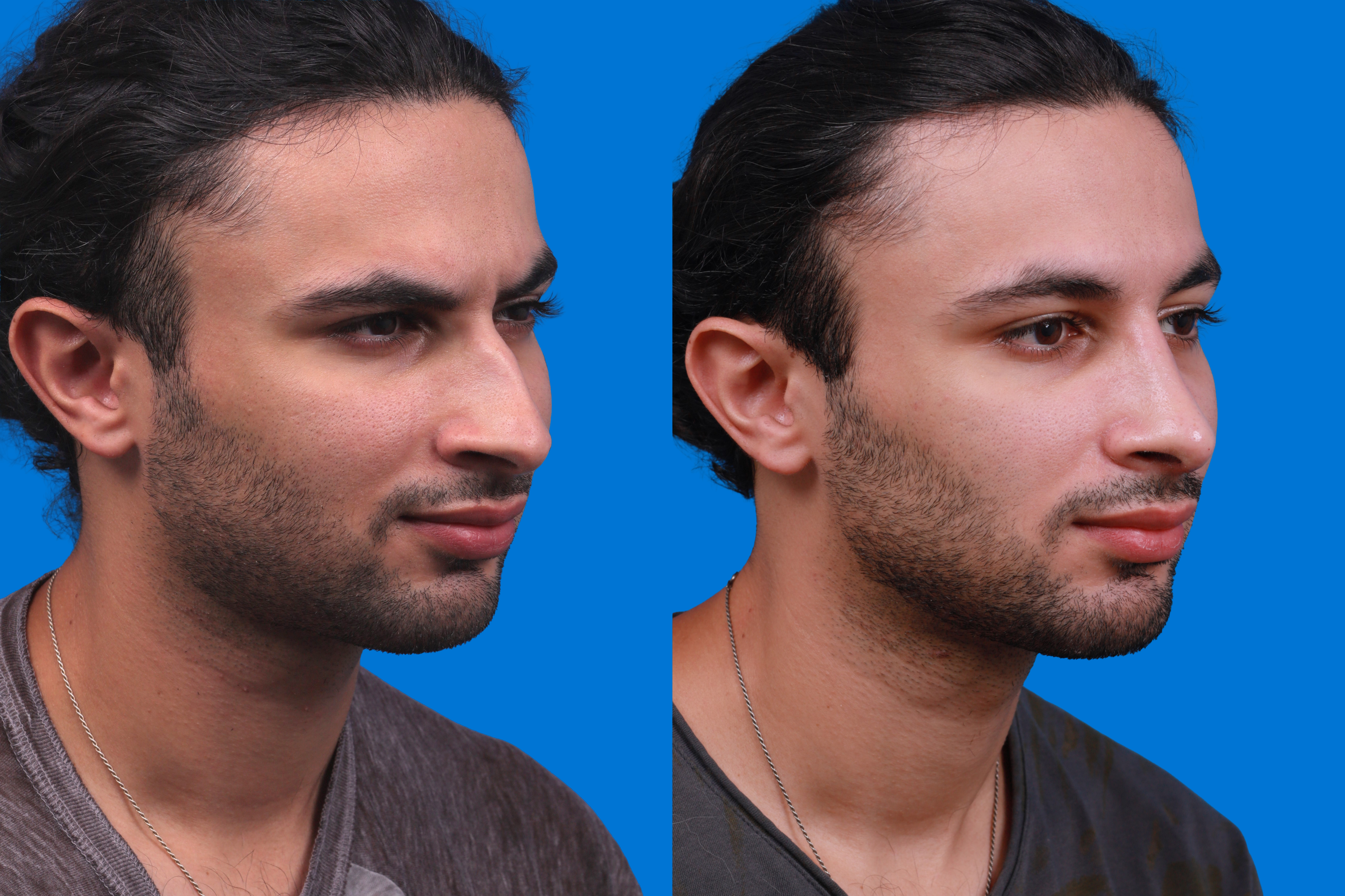 Rhinoplasty Before & After Gallery - Patient 179166674 - Image 2