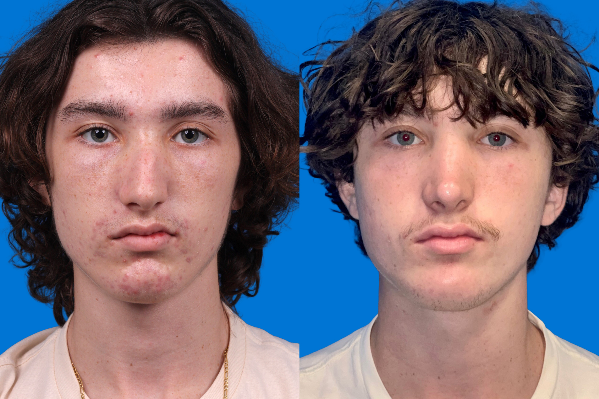 Rhinoplasty Before & After Gallery - Patient 159366 - Image 1