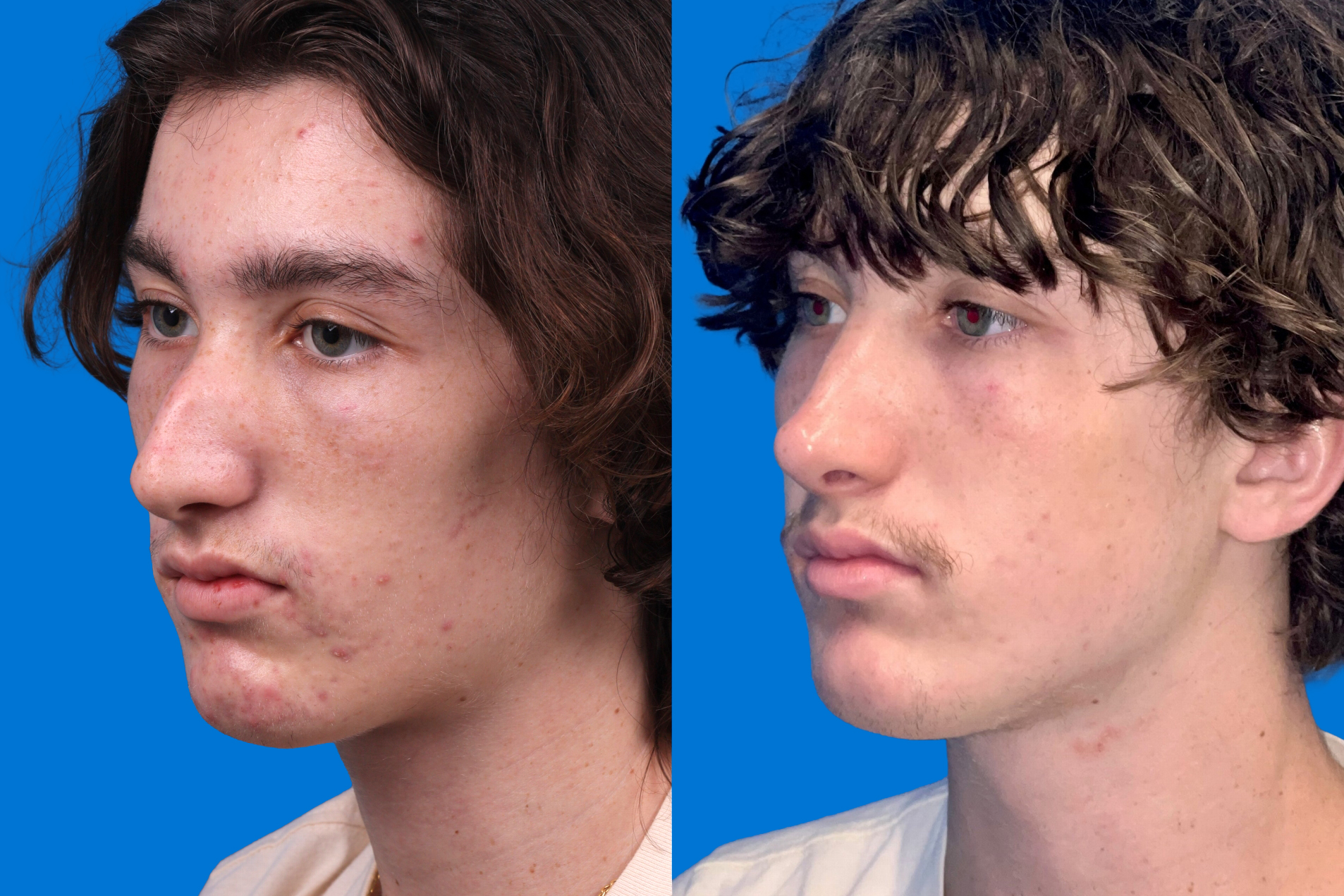 Rhinoplasty Before & After Gallery - Patient 159366 - Image 4