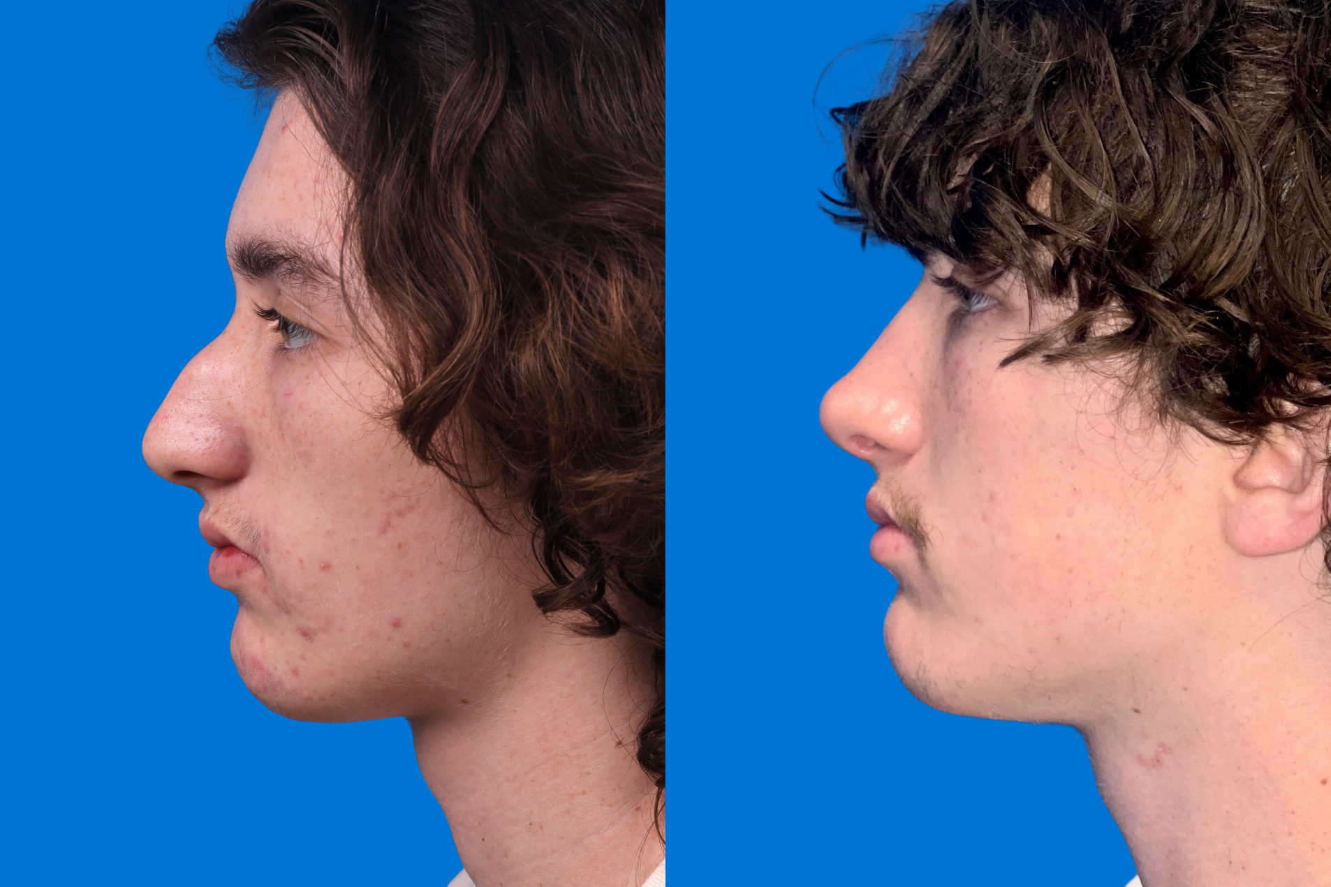 Rhinoplasty Before & After Gallery - Patient 159366 - Image 5
